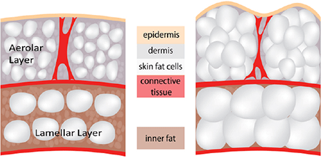cellulite